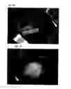 Fig. 07 - Antiadhesive Kit and Method of Adhesion Prevention