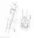 Fig. 04 - Split-tip catheter including lateral distal openings