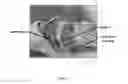 Fig. 03 - Obstructive Sleep Apnea Treatment Device