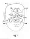 Fig. 02 - Devices and Methods for Dilating a Paranasal Sinus Opening and for Treating Sinusitis