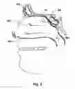 Fig. 03 - Devices and Methods for Dilating a Paranasal Sinus Opening and for Treating Sinusitis