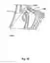 Fig. 11 - Devices and Methods for Dilating a Paranasal Sinus Opening and for Treating Sinusitis