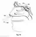 Fig. 12 - Devices and Methods for Dilating a Paranasal Sinus Opening and for Treating Sinusitis