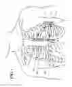 Fig. 02 - Extravascular lead designs for optimized pacing and sensing having segmented, partially electrically insulated defibrillation coils