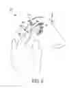 Fig. 04 - Stimulation devices and methods for treating dry eye