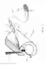 Fig. 06 - Extended pain relief via high frequency spinal cord modulation, and associated systems and methods