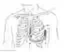 Fig. 01 - Implantable cardioverter-defibrillator (ICD) system having multiple common polarity extravascular defibrillation electrodes