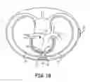 Fig. 03 - Implantable cardioverter-defibrillator (ICD) system having multiple common polarity extravascular defibrillation electrodes