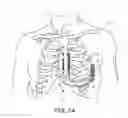 Fig. 04 - Implantable cardioverter-defibrillator (ICD) system having multiple common polarity extravascular defibrillation electrodes