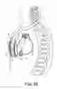 Fig. 05 - Implantable cardioverter-defibrillator (ICD) system having multiple common polarity extravascular defibrillation electrodes