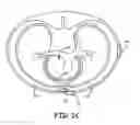 Fig. 06 - Implantable cardioverter-defibrillator (ICD) system having multiple common polarity extravascular defibrillation electrodes