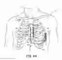 Fig. 08 - Implantable cardioverter-defibrillator (ICD) system having multiple common polarity extravascular defibrillation electrodes