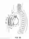 Fig. 09 - Implantable cardioverter-defibrillator (ICD) system having multiple common polarity extravascular defibrillation electrodes