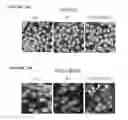Fig. 19 - Replication factor C-40 (RFC40/RFC2) as a prognostic marker and target in estrogen positive and negative and triple negative breast cancer
