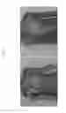 Fig. 02 - Treatment of hyperhidrosis