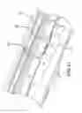Fig. 22 - Methods and systems for delivering an implant using a planetary gear actuation assembly