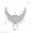Fig. 04 - Shaped-charge liner with fold around opening