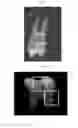 Fig. 02 - Method, systems and kit for forensic identification, post mortem interval estimation and cause of death determination by recovery of dental tissue in physiological conditions