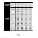 Fig. 03 - NOVEL MAGNETIC RESONANCE IMAGE TECHNIQUE FOR IMAGING AND EVALUATING COLLATERAL CIRCULATION