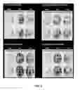 Fig. 06 - NOVEL MAGNETIC RESONANCE IMAGE TECHNIQUE FOR IMAGING AND EVALUATING COLLATERAL CIRCULATION