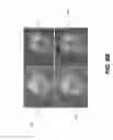 Fig. 10 - Detection of tooth condition using reflectance images with red and green fluorescence