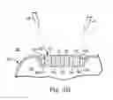 Fig. 05 - Ceramic feedthrough brazed to an implantable medical device housing