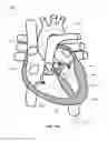 Fig. 17 - SYSTEM AND APPARATUS COMPRISING A MULTISENSOR GUIDEWIRE FOR USE IN INTERVENTIONAL CARDIOLOGY