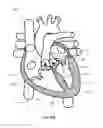 Fig. 20 - SYSTEM AND APPARATUS COMPRISING A MULTISENSOR GUIDEWIRE FOR USE IN INTERVENTIONAL CARDIOLOGY