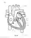 Fig. 35 - SYSTEM AND APPARATUS COMPRISING A MULTISENSOR GUIDEWIRE FOR USE IN INTERVENTIONAL CARDIOLOGY