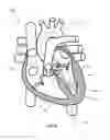 Fig. 37 - SYSTEM AND APPARATUS COMPRISING A MULTISENSOR GUIDEWIRE FOR USE IN INTERVENTIONAL CARDIOLOGY