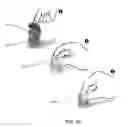 Fig. 43 - Medical device inserters and processes of inserting and using medical devices