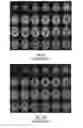 Fig. 02 - Amyloid PET brain scan quantification based on cortical profiles
