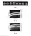Fig. 05 - Amyloid PET brain scan quantification based on cortical profiles
