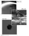Fig. 10 - Retrieving high spatial frequency information in sonography