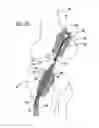 Fig. 15 - Flexible planar member for tissue fixation