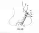 Fig. 16 - Flexible planar member for tissue fixation