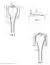 Fig. 04 - Tissue displacement tools and methods