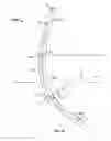 Fig. 22 - Tissue displacement tools and methods