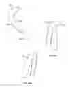 Fig. 31 - Tissue displacement tools and methods