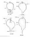 Fig. 54 - Tissue displacement tools and methods