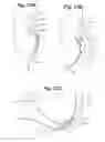 Fig. 22 - Devices and Methods for Minimally Invasive Access to Sinuses and Treatment of Sinusitis