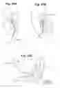 Fig. 24 - Devices and Methods for Minimally Invasive Access to Sinuses and Treatment of Sinusitis