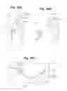 Fig. 27 - Devices and Methods for Minimally Invasive Access to Sinuses and Treatment of Sinusitis