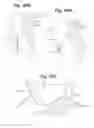 Fig. 28 - Devices and Methods for Minimally Invasive Access to Sinuses and Treatment of Sinusitis