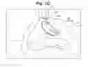 Fig. 03 - Devices and Methods For Minimally Invasive Access To Sinuses and Treatment of Sinusitis