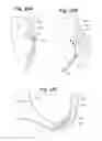 Fig. 22 - Devices and Methods For Minimally Invasive Access To Sinuses and Treatment of Sinusitis