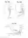 Fig. 23 - Devices and Methods For Minimally Invasive Access To Sinuses and Treatment of Sinusitis