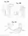 Fig. 28 - Devices and Methods For Minimally Invasive Access To Sinuses and Treatment of Sinusitis