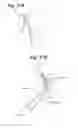 Fig. 35 - Devices and Methods For Minimally Invasive Access To Sinuses and Treatment of Sinusitis