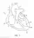 Fig. 02 - SYSTEM AND METHOD FOR TRANSAPICAL ACCESS AND CLOSURE